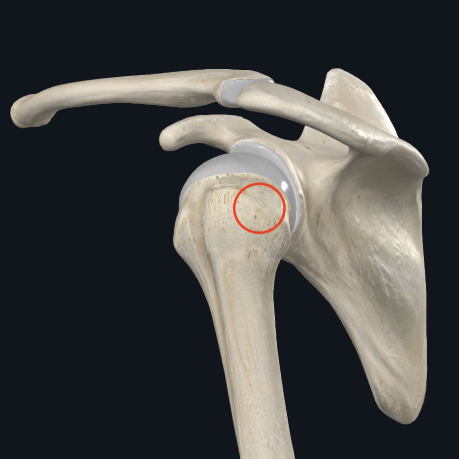 <p>Quel muscle se fixe sur la partie moyenne du <strong><em>tuberculus majus humeri</em></strong> (face <strong><em>moyenne</em></strong> du grand tubercule de l’humérus) ?</p>