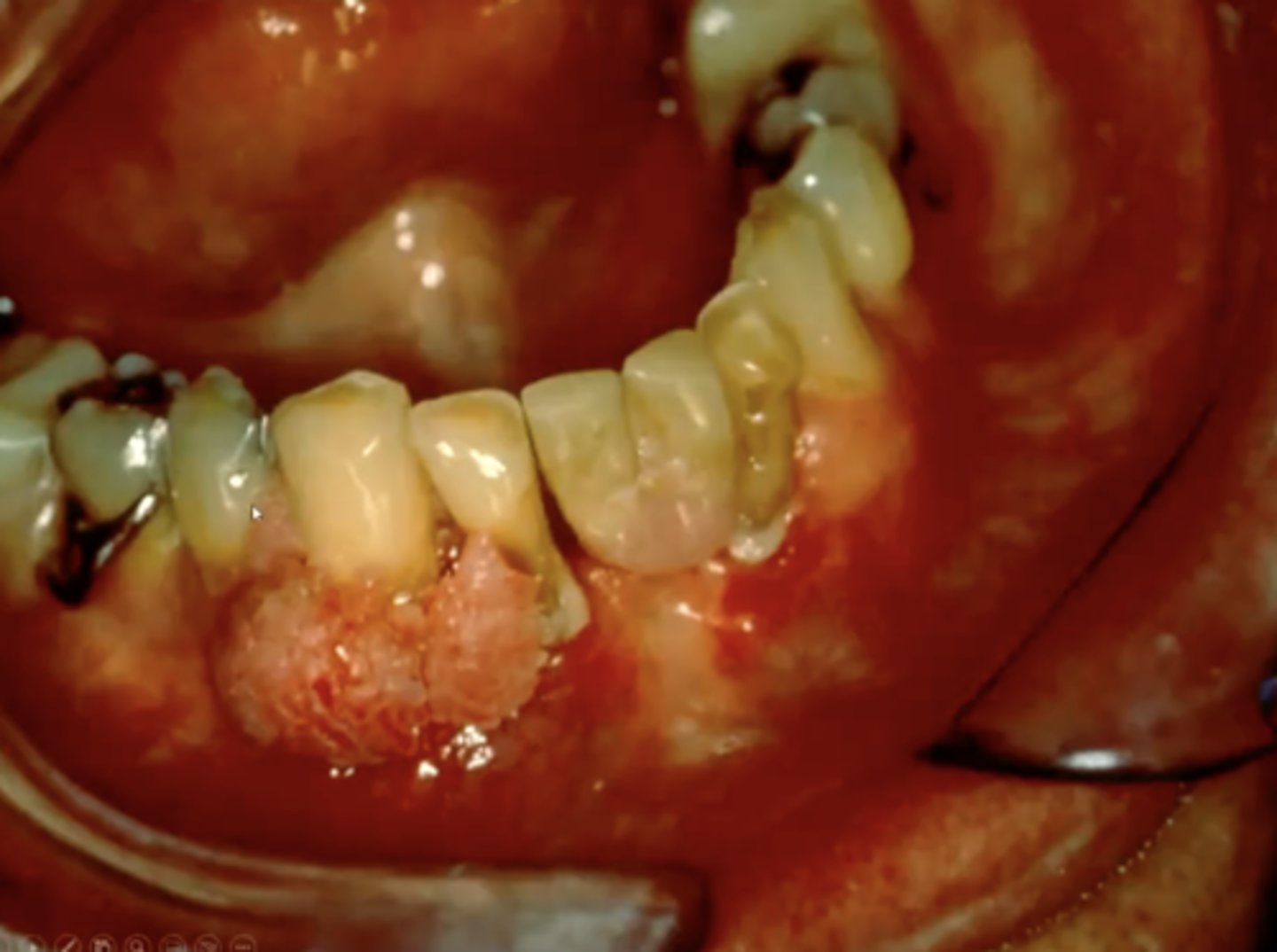 <p>benign warts found on genitalia or oral cavity that present as pink, short, sessile papillary projections</p>