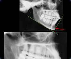 <p>Most anterior midline point on the chin of the mandible</p>