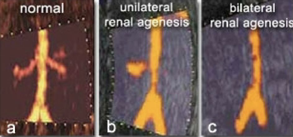 <ul><li><p>kidneys / bladder absent on US</p></li><li><p>severe oligohydramnios or anhydramnios</p></li><li><p>Check for Renal Artery flow w/ PD</p></li></ul><p></p>