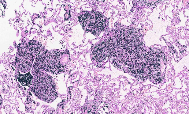 <p>Neumoconiosis de los trabajadores del carbón</p>