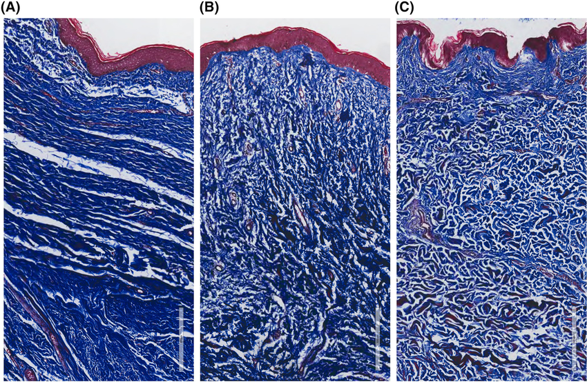 <p>Use Masson's Trichrome; high-density blue/green staining indicates excessive collagen deposition. </p>