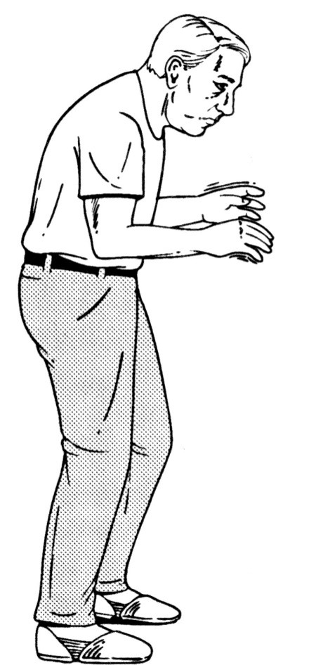 <p>parkinson’s disease is a hypokinetic disorder</p>