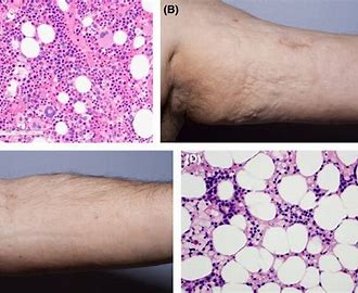 <p>Cause: decrease RBC production</p><p>-radiation, chemotherapy, &amp; toxins</p><p>-decrease in hematopoietic stem cells in bone marrow</p><p>-decreased in number</p><p>-stem cell deficiency</p><p>-normocytic, normochromic OR megaloblastic</p>