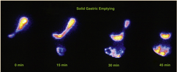 <p><span><span>•Rapid filling</span></span></p><p><span><span>•Spontaneous emptying by approximately:</span></span></p><p><span><span>•30% after 30 mins</span></span></p><p><span><span>•50% within 40 mins</span></span></p><p></p>