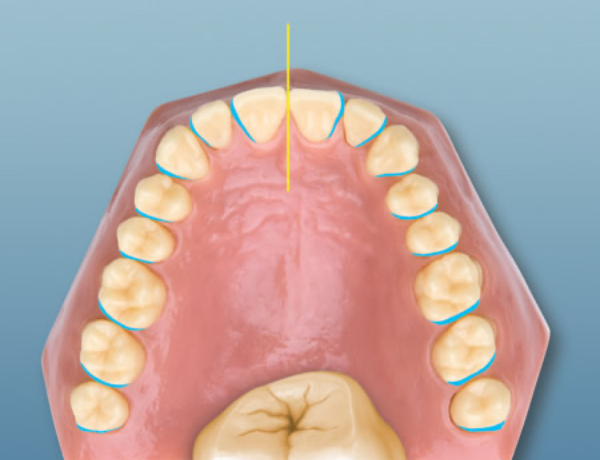 <p>Surface of the tooth distant from the midline.</p>