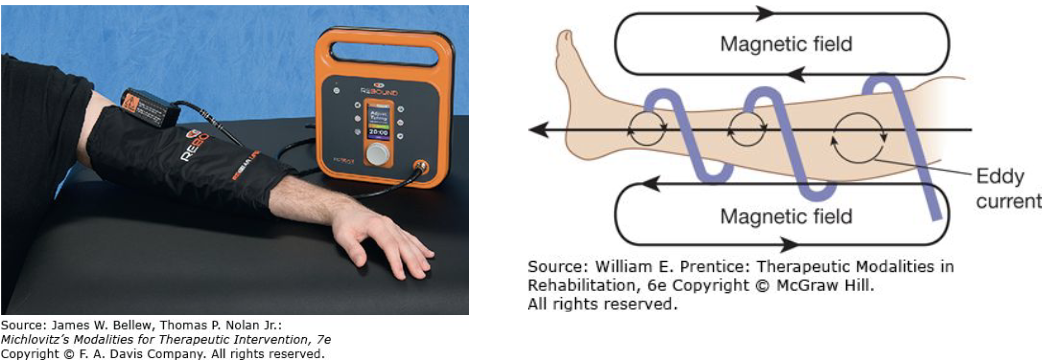 <ul><li><p><span>An induction sleeve is a new method of delivering diathermy to a patient</span></p></li><li><p><span>Deliver shortwave diathermy at a power of 35 W and a frequency of 13.56 MHz</span></p></li><li><p><span>Sleeves are designed to fit around a body part</span></p><ul><li><p><span>Heating ability is limited to moderate tissue temperature increases</span></p></li></ul></li><li><p><span>Increases ease of application</span></p></li><li><p><span>It is important that the cables not touch each other because they will short out and cause excessive heat buildup</span></p></li></ul><p></p>