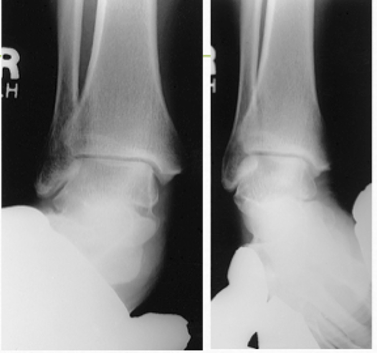 <p>- Distal aspect of tibia and fibula demonstrated</p><p>- Ankle joint to center of collimation field</p><p>- Optimal exposure factors</p>