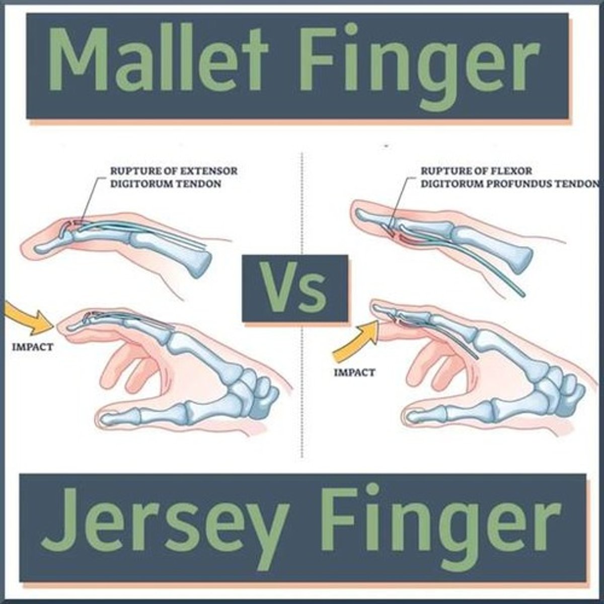 <p>Tenderness in the antecubital fossa, often with a 'Popeye sign' and positive hook test.</p>
