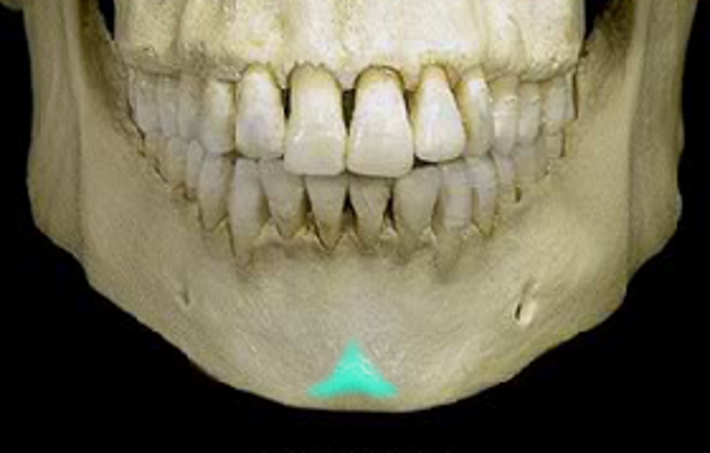 <p>What is the flat triangular area on the mandible that is marked by two knoblike protuberances that project forward?</p>