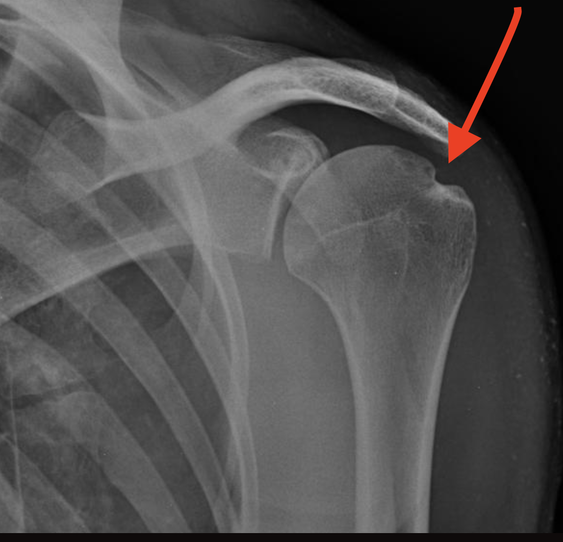 <p>Cortical depression in the posterolateral head of the humerus that results from a forceful impaction of the humeral head against the glenoid rim when the shoulder is dislocated anteriorly</p>