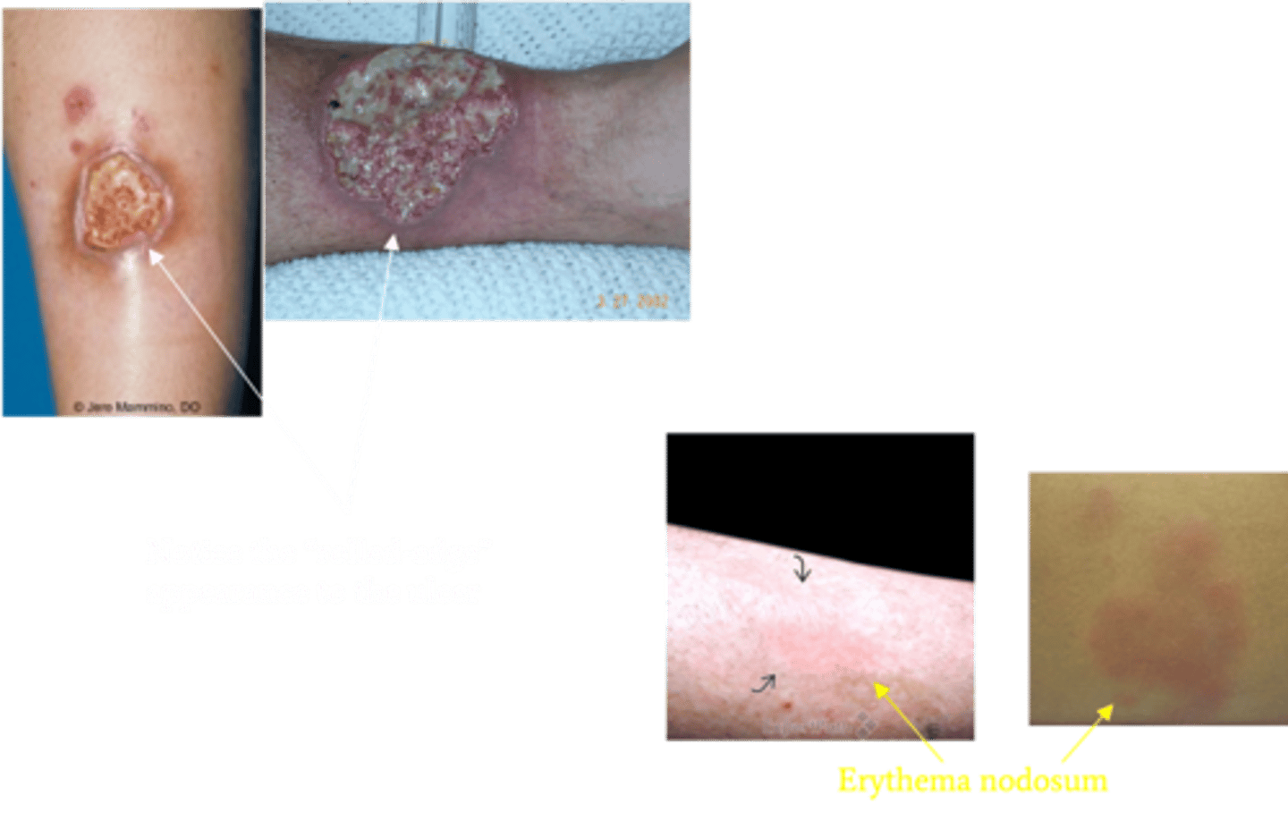 <p>Define Condition:</p><p>Crohn Disease (Ileum) + Ulcerative colitis (Rectum); Dx of Exclusion</p><p>-Hx:</p><p>&gt; Bimodal Age Distribution</p><p>&gt;&gt; Age 15-30 y/o</p><p>&gt;&gt; Age 50-80 y/o</p><p>&gt; More in White, Jewish Populations</p><p>&gt;&gt; Female = Crohn (hormones)</p><p>&gt;&gt; Male = UC</p><p>&gt; Vit D Deficiency</p><p>-Sx/PE:</p><p>&gt; Episodes/Flares</p><p>&gt; Arthritis (peripheral joints, Ankylosing Spondylitis, Sacroiliitis, Migratory Polyarthritis)</p><p>&gt; Erythema nodosum (painful)</p><p>&gt; Pyoderma gangrenosum</p><p>&gt;&gt; MC in 50s to 60s</p><p>&gt;&gt; Deep, necrotic skin ulceration</p><p>&gt;&gt; Distinctive rolled edges and violaceous border, more common in Crohn</p><p>&gt;&gt; Need to treat main cause</p><p>&gt; PSC (in UC)</p><p>&gt; Uveitis</p><p>-Dx:</p><p>&gt; Elevated CRP</p><p>&gt; Elevated ESR</p>
