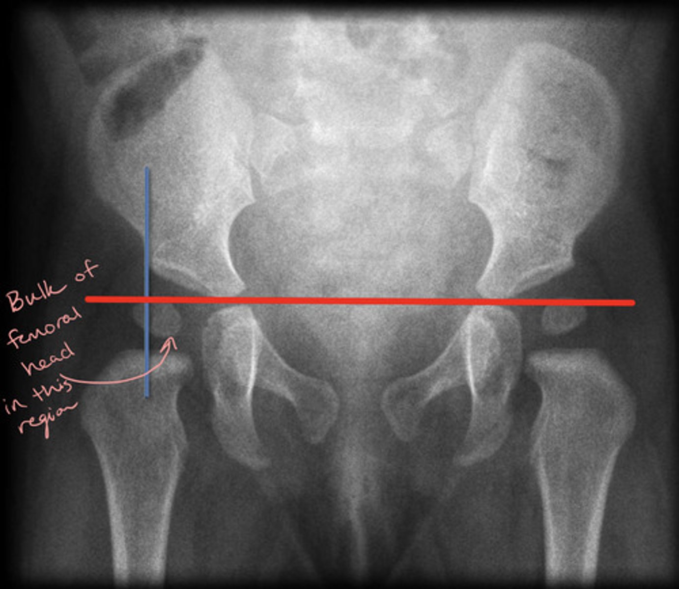 <p>Line drawn vertically through the lateral most aspect of the acetabular roof perpendicular to Hilgenreiner's line</p><p>The ossified femoral head should be located in the inferomedial quadrant created</p>