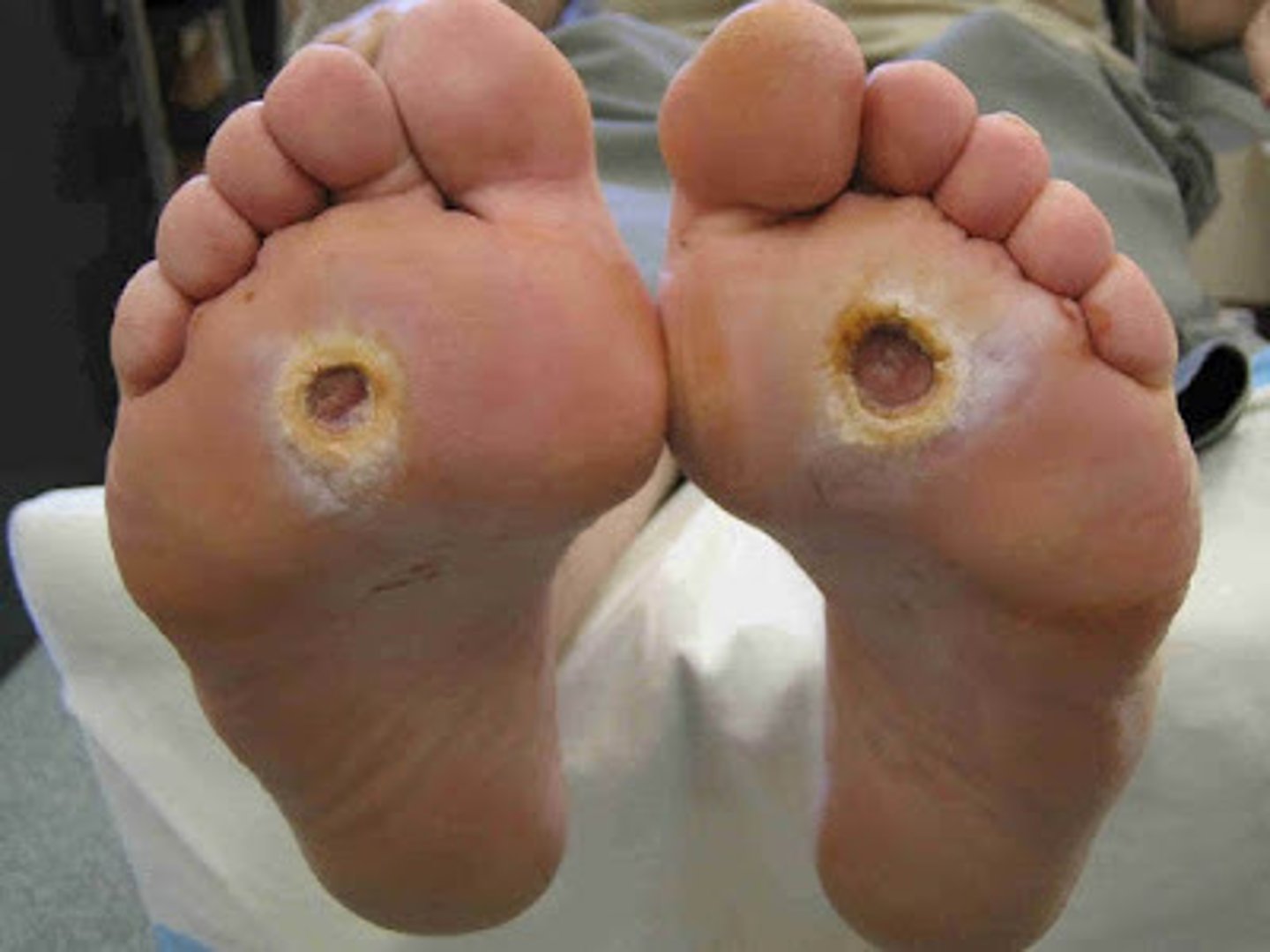 <p>MOST COMMON CAUSE OF LE AMPUTATION</p><p>CONTRIBUTING FACTORS:</p><p>- neuropathy</p><p>- PAD</p><p>- structural deformities</p><p>- altered biomechanics </p><p>(Charcot foot)</p><p>COMMON LOCATION--> feet and toes</p><p>*metatarsal heads, hallux, plantar surface</p><p>**usually caused by pressure due to improper footwear</p><p>***thick CALLOUS usually present</p>