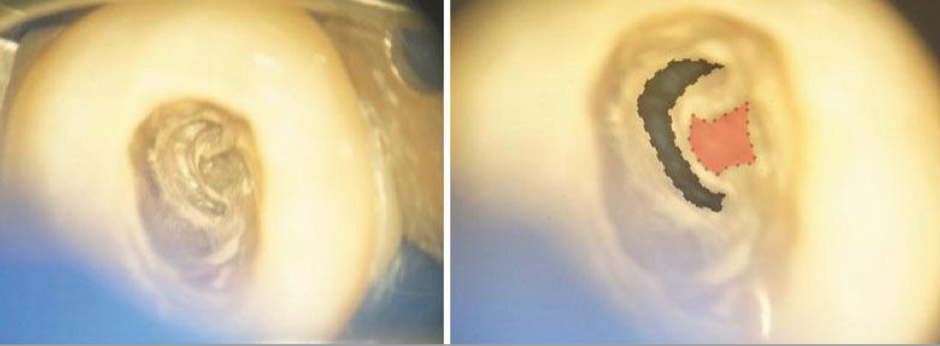 <p>3rd root</p><p>1 conical root with c shaped canal&nbsp;</p>