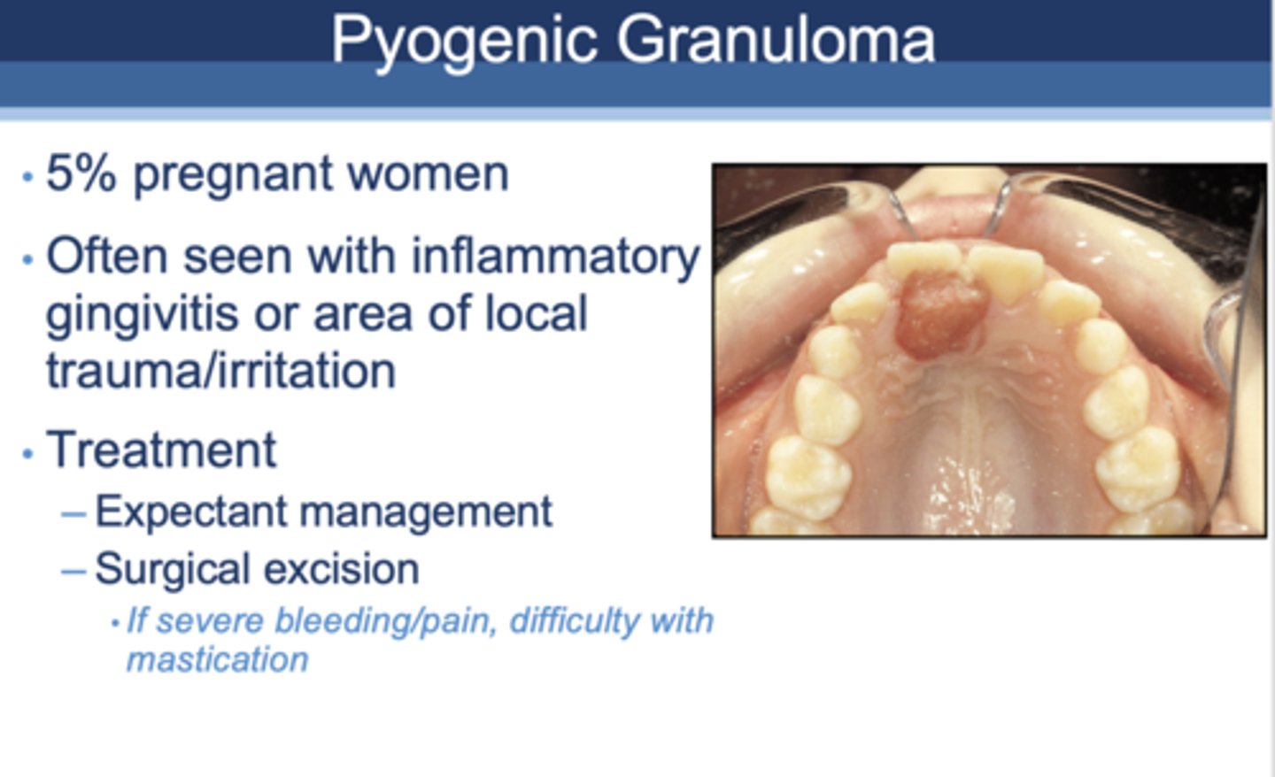<p>Pyogenic Granuloma</p>
