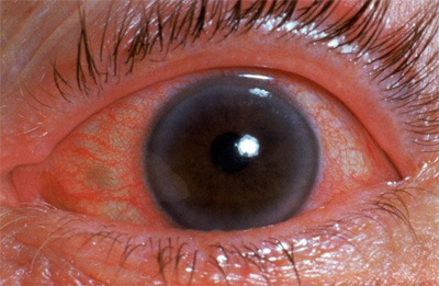 <p>Acute angle closure glaucoma</p>