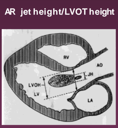 <p>Parasternal LAX. It compares the regurgitant jet height to the LVOT height.</p>