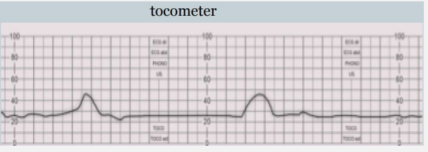 <p><strong>Hypocontractile Uterine Activity</strong></p><p>-Most common risk factor for protraction/arrest disorder in _____ stage of labor </p><p>-Uterine activity not sufficiently _____ or not appropriately ___________ to dilate cervix or expel _____</p>