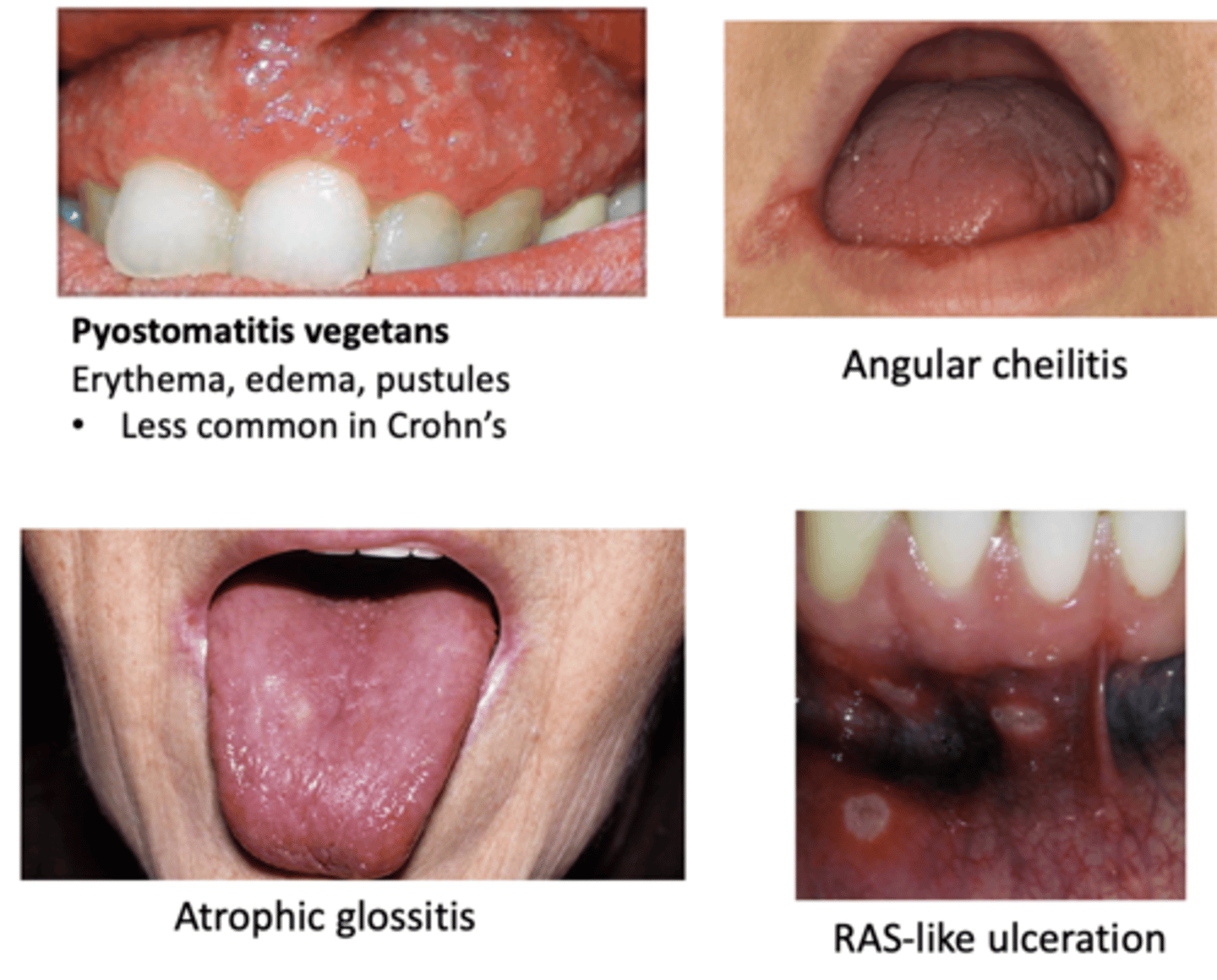 <p>Oral manifestations of this GI disease include:</p><p>- Pyostomatitis vegetans (Erythema, edema, pustules) </p><p>- RAS-like ulceration</p><p>- Angular cheilitis</p><p>- Atrophic glossitis</p>