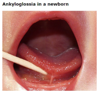 <p><strong>Ankyloglossia </strong></p><p>-_______ frenulotomy has been shown to decrease nipple ____ and may facilitate breastfeeding </p><p>-Colloquially known as being tongue tied </p>