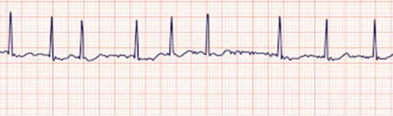 <p>Atrial Fibrillation</p>