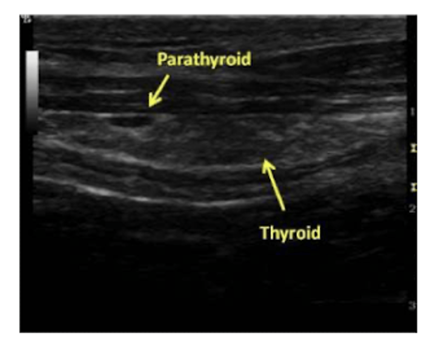 <p>SI- ecografía cervical, de las glándulas tiroideos.</p><p>→ ↑ tamaño (>0.8mm)</p>