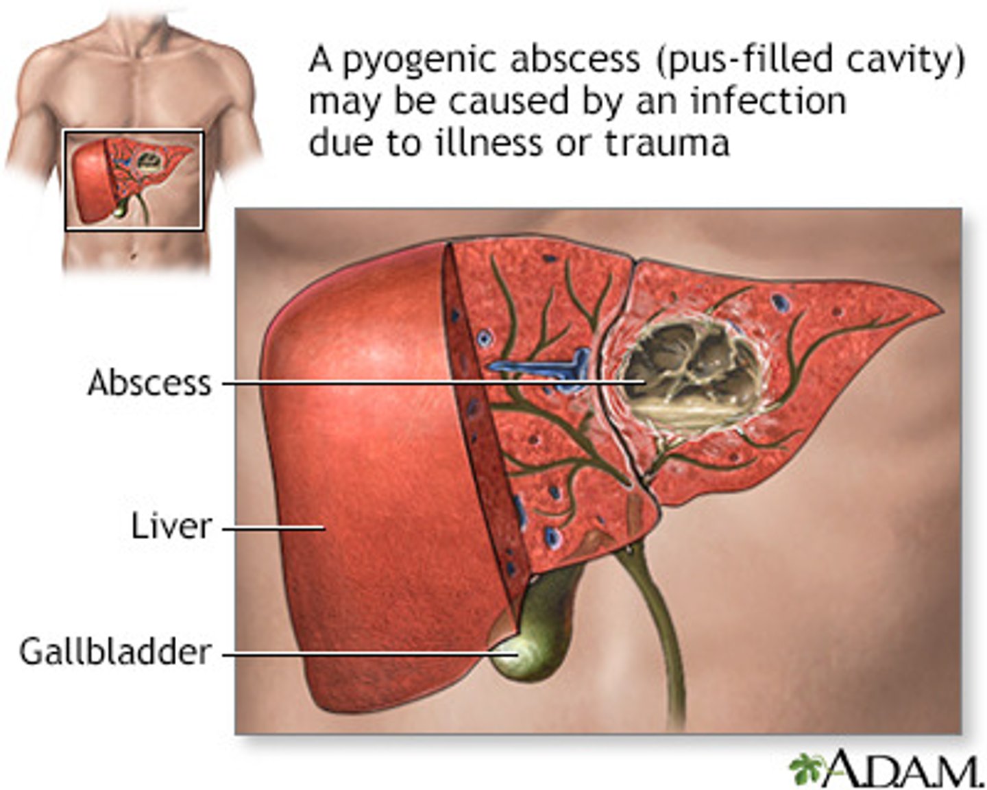 <p>Pyogenic abscess</p><p>- liquefactive necrosis with neutrophil infiltration</p>