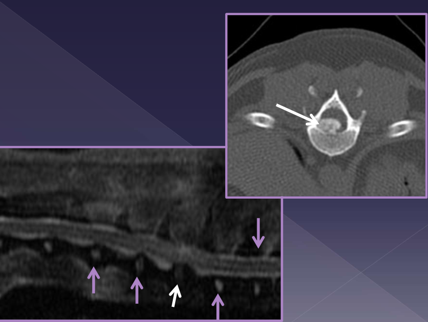 <ul><li><p>spinal radiographs </p><ul><li><p>35% accurate </p></li><li><p>rule out differentials </p><ul><li><p>diskospondylitis </p></li><li><p>neoplasia </p></li><li><p>trauma </p></li></ul></li><li><p>identify </p><ul><li><p>foraminal changes / mineralization </p></li><li><p>narrowing/wedging of disc space </p></li><li><p><strong>mineralized disk IN SITU </strong></p></li></ul></li></ul></li><li><p>CT </p></li><li><p>MRI </p></li></ul><p></p>
