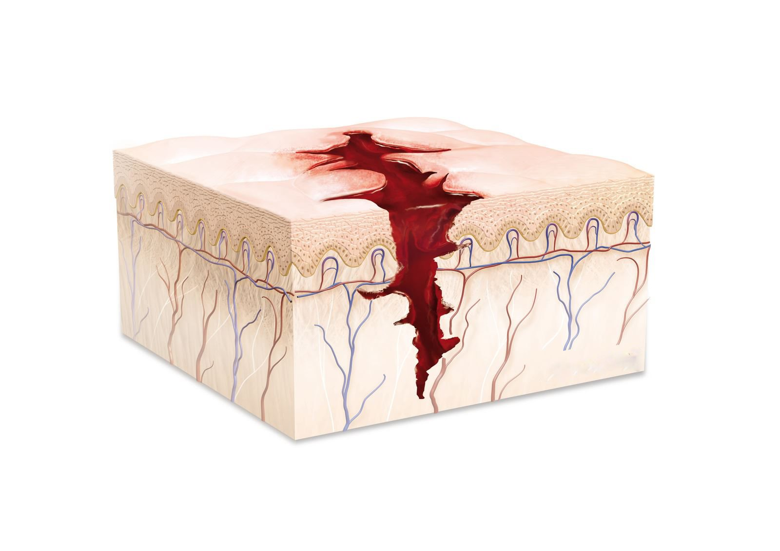 <p>What is a wound produced by the tearing and/or splitting of body tissue?</p>