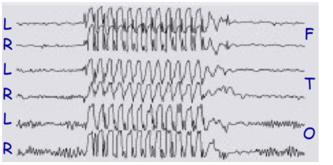 <p>Describe the EEG pattern of absence seizures</p>
