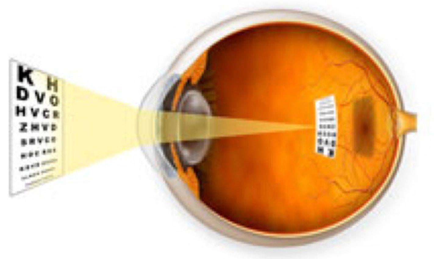 <p>known as Myopia, an elongated eye causes light rays from each eye to meet before they hit the retina causing a distortion</p>