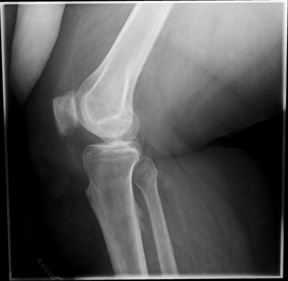 <p>what is the image critique for this lateral knee?</p>