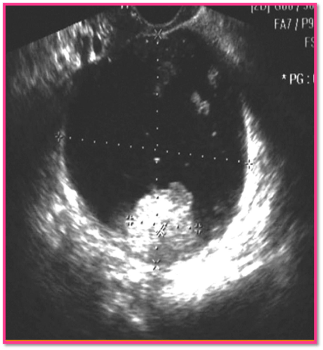 <p>calcifications</p>