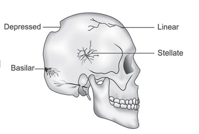 <ul><li><p><strong>Stellate fractures</strong> are star-shaped with multiple radiating cracks from a heavy, low-velocity impact, often on upper parietals and sometimes with depressed fractures.</p></li><li><p><strong>Comminuted fractures</strong> involve bone fragmentation from heavy, low-speed crushing forces, usually on skull convexities, making full reconstruction nearly impossible.</p></li></ul><p></p>