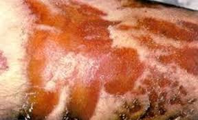 <p>Aspecto amarillento, sin reacción inflamatoria, por fricción tangencial, desprendimiento del estato córneo</p>