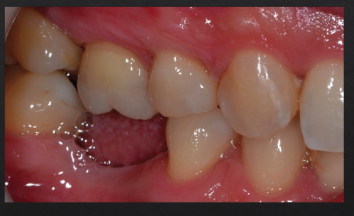 <p>what consequences may occur when there is no occluding antagonist to a teeth?</p>