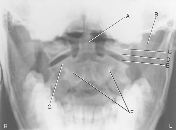 <p>The structure designated as A is the:</p><p>a. Right superior articular</p><p>b. Left zygapophyseal joint surface of C2</p><p>c. Body of C2</p><p>d. Left transverse process of C1</p><p>e. Centrally located dens</p><p>f. Left lateral mass of C1</p><p>g. Inferior articular surface of C1</p>