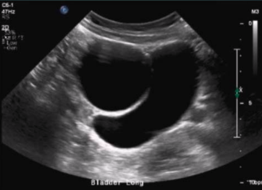 <ul><li><p>About 30% of cases </p></li><li><p>Both ends close off, and a cyst forms in the middle</p></li></ul><p></p>