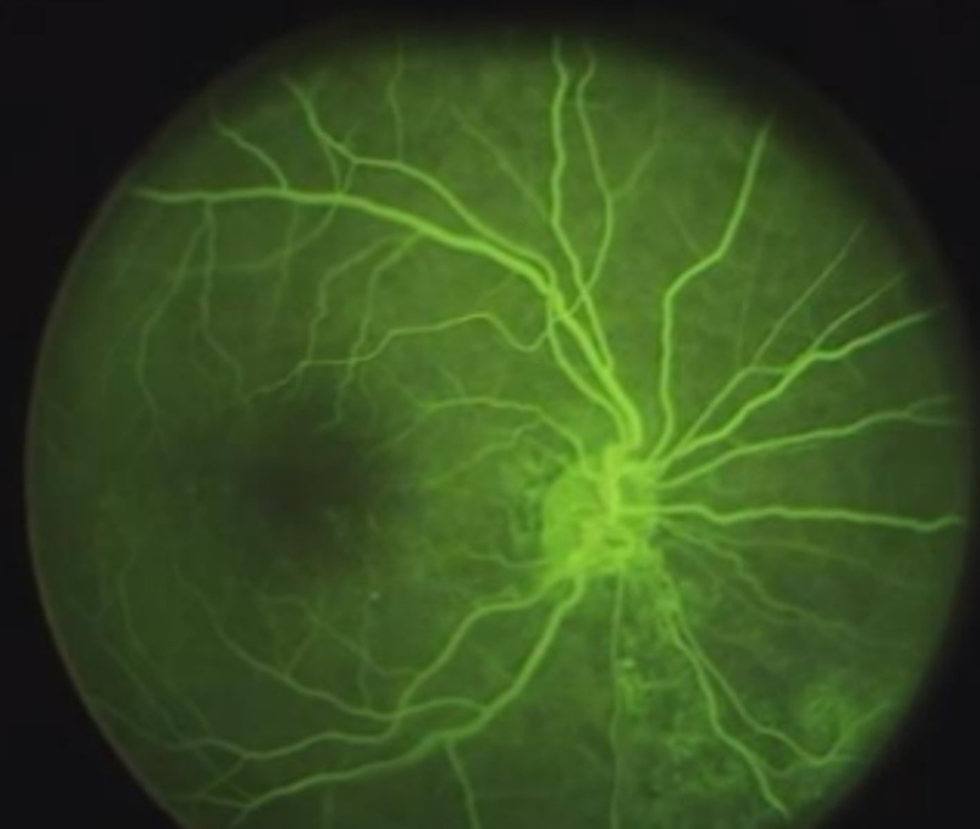 <p>fluorescein dye can be injected to examine choroidal and retinal circulation.</p><p></p><p><strong><span style="text-decoration:underline">within 10 seconds</span></strong>, choroidal flush</p><p>→ dye leaks out of fenestrated choriocapillaris</p><p>→<span class="bgP"> dye should </span><strong><span class="bgP">NOT</span></strong><span class="bgP"> leak into the retina because RPE is </span><strong><span class="bgP">not fenestrated</span></strong></p><p></p><p><strong><span style="text-decoration:underline">within 12 seconds</span></strong>, retinal arteries fill, then retinal veins.</p><p></p><p><span class="bgP">defects in the RPE can be seen if the dye leaks into the retina </span><strong><span class="bgP">BEFORE</span></strong><span class="bgP"> the retinal vessels fill (during choroidal flush)</span></p>