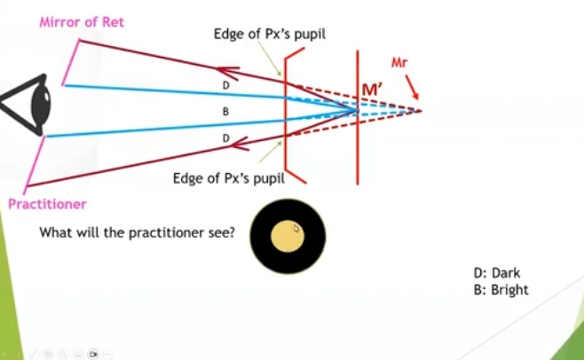 <p>high hyperopia </p>