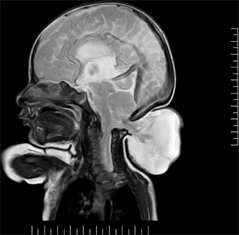 <p>terrible birth defect where cerebellum herniates outside the skull, called a myelomeningocele</p>