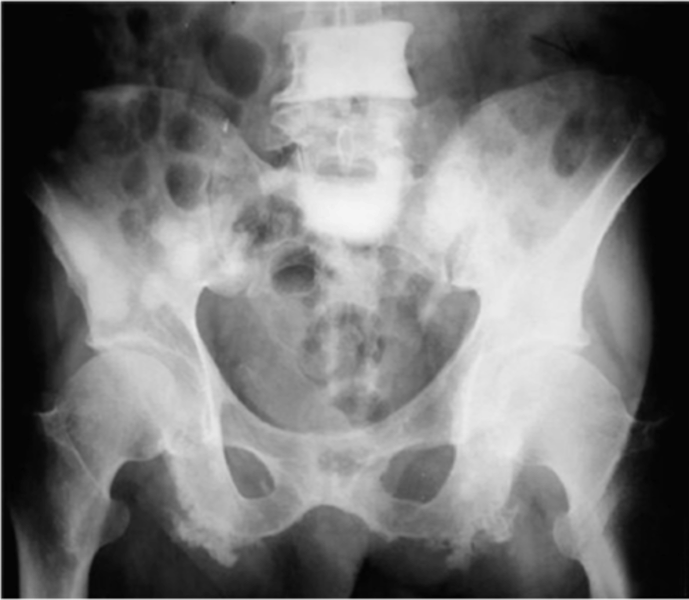 <p>ID radiologic pattern of disease</p>
