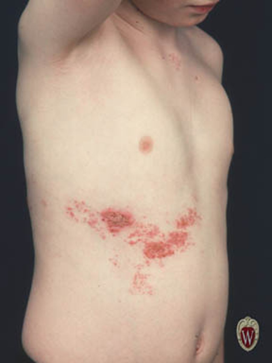 <p>Dermatomal/Zosteriform</p>