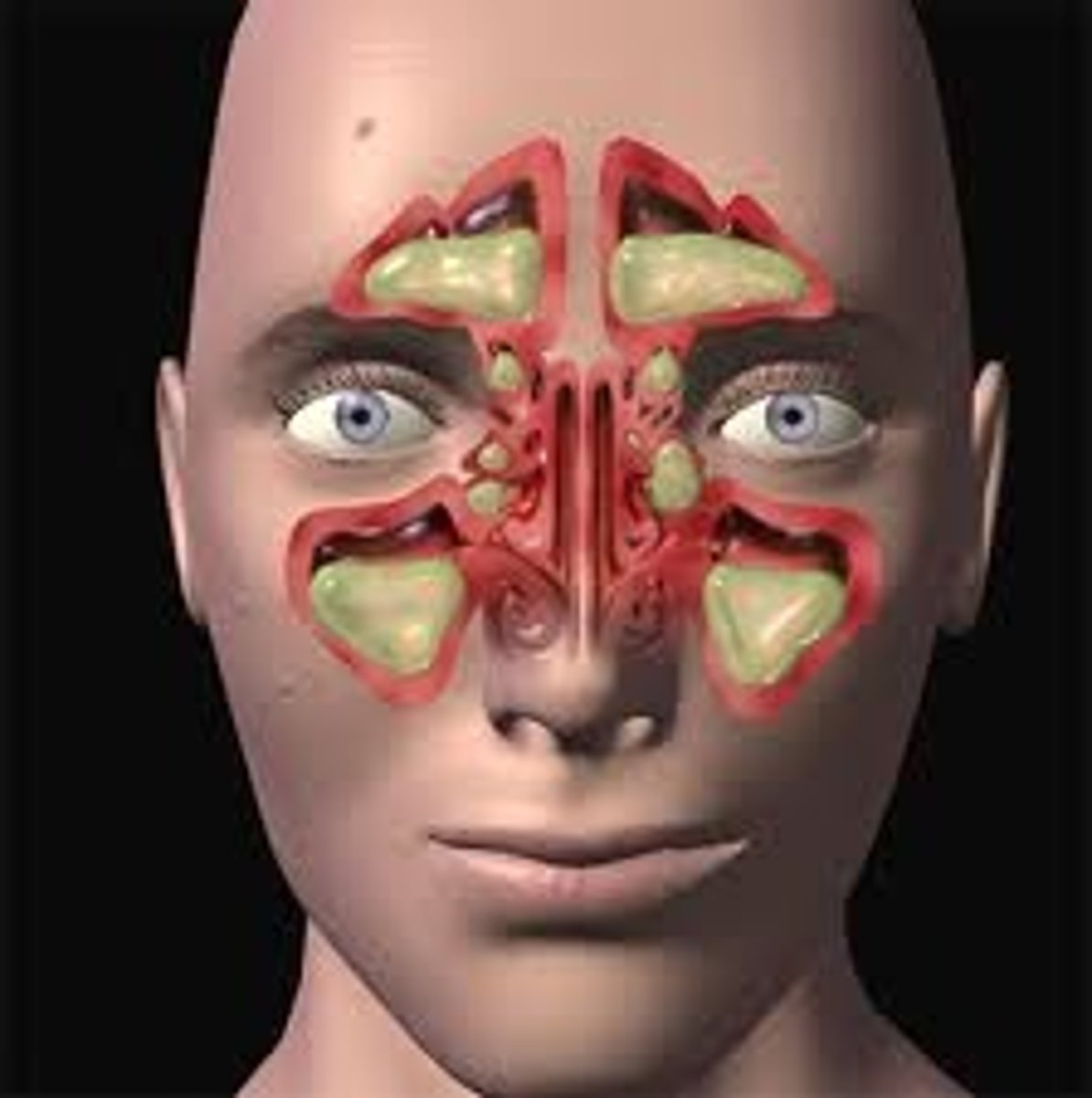 <p>(def) inflammation of the sinuses</p>