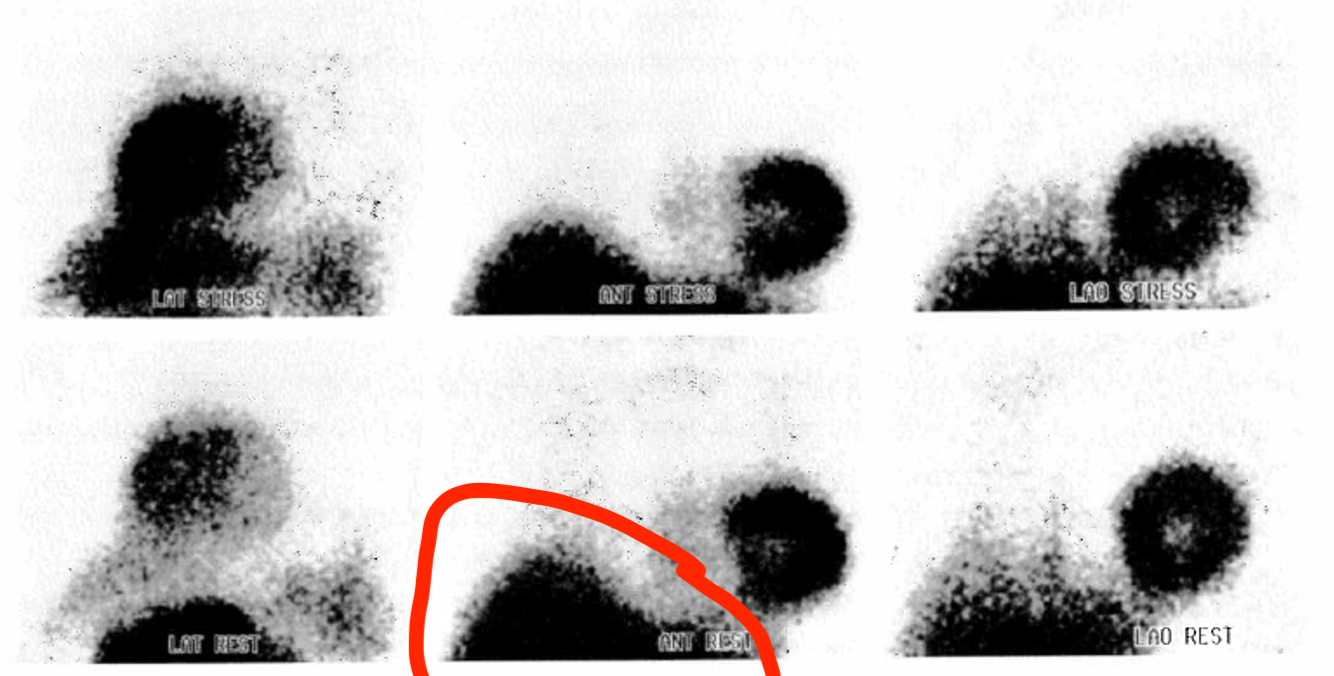 <p>This is a photo of a planar Sestamibi MPI image, what might the circled object be?</p>