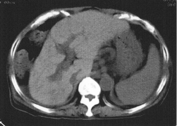 <p>Cirrhosis - atrophy of right lobe</p>