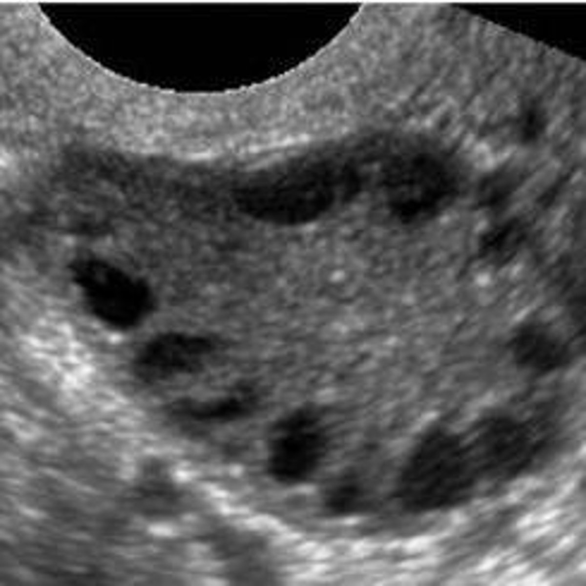 <p>The 'string of pearls' appearance, defined as 12 or more follicles (2-9 mm) or increased ovarian volume (> 10 mL).</p>