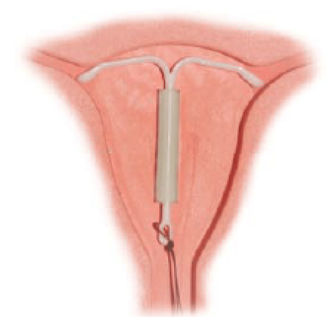 <p>placed inside uterus by a doctor + works by releasing a small amount of progestin each day to keep you from getting pregnant + typically stays from 3 to 10 years</p>