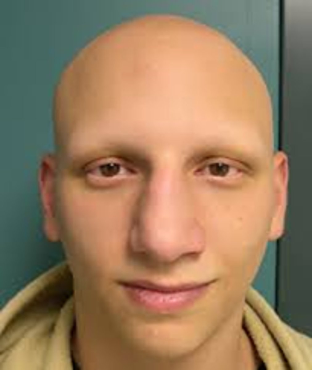 <p>complete loss of body hair.</p>